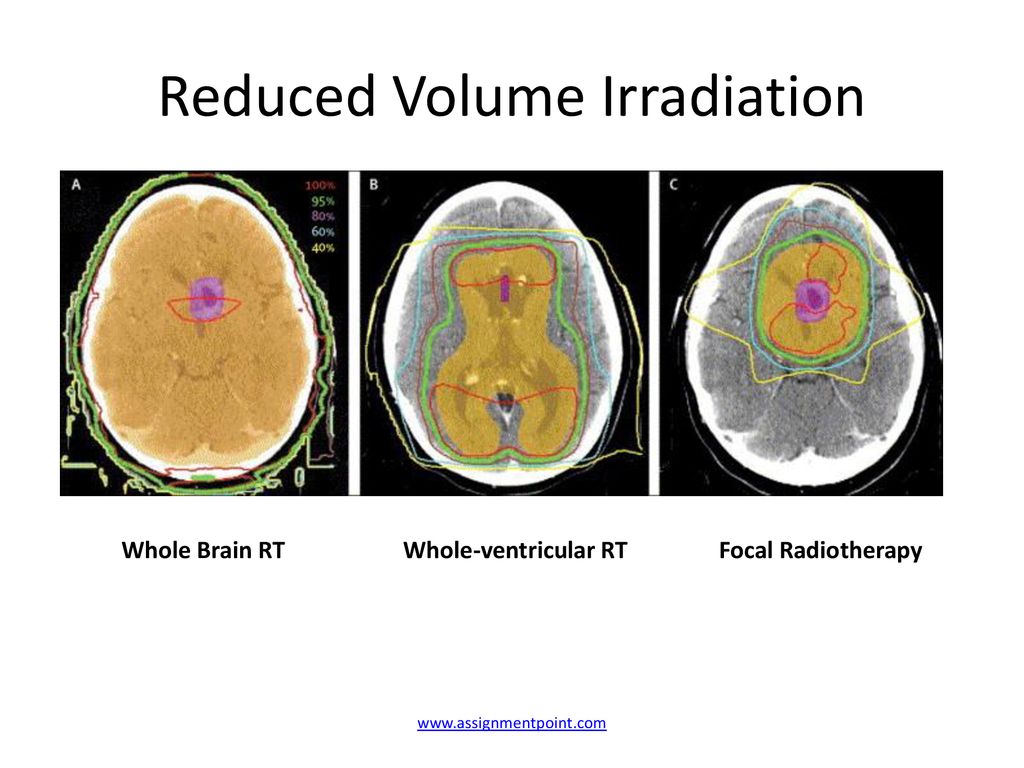 Germinomas: Evolution in the Use of Radiation - ppt download