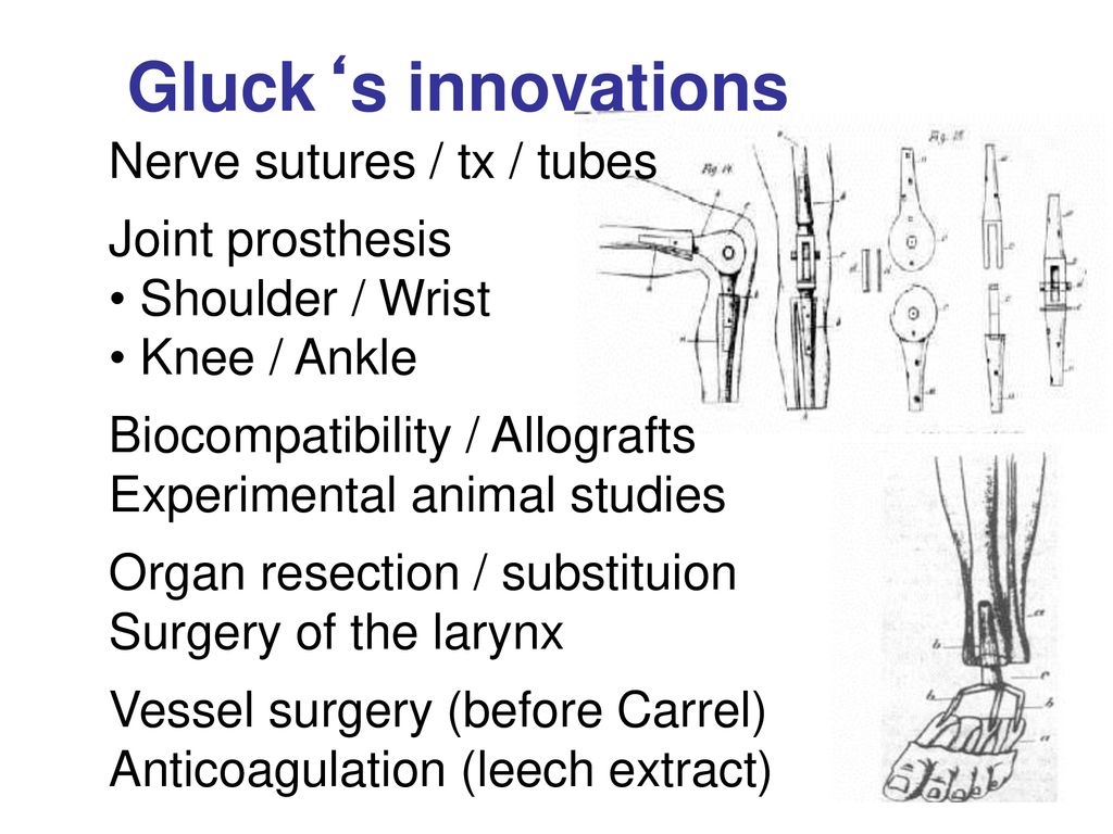 Gluck‘s innovations Nerve sutures / tx / tubes Joint prosthesis