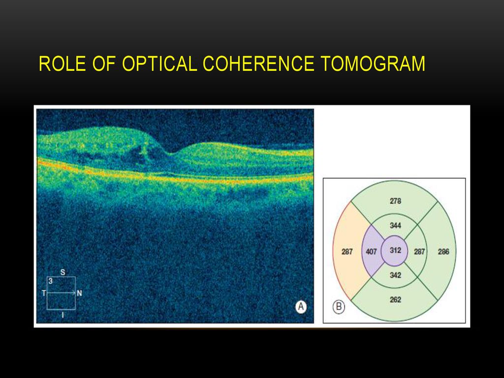 ROLE OF OPTICAL COHERENCE TOMOGRAM