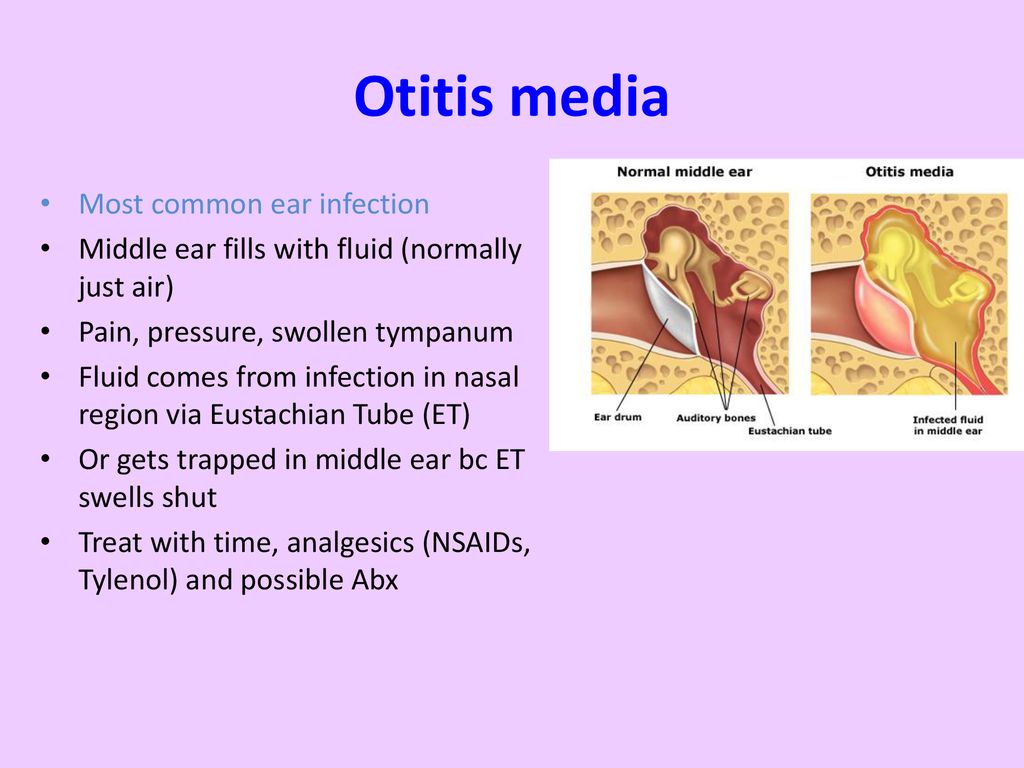 Otitis media Most common ear infection