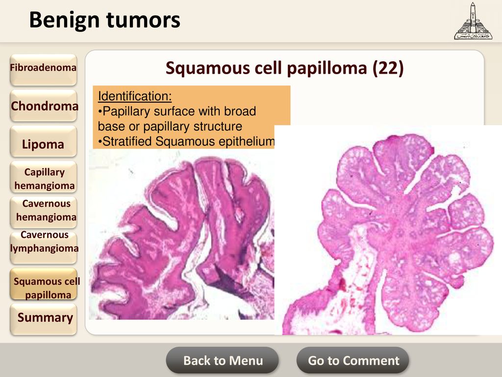 papilloma vs lipoma