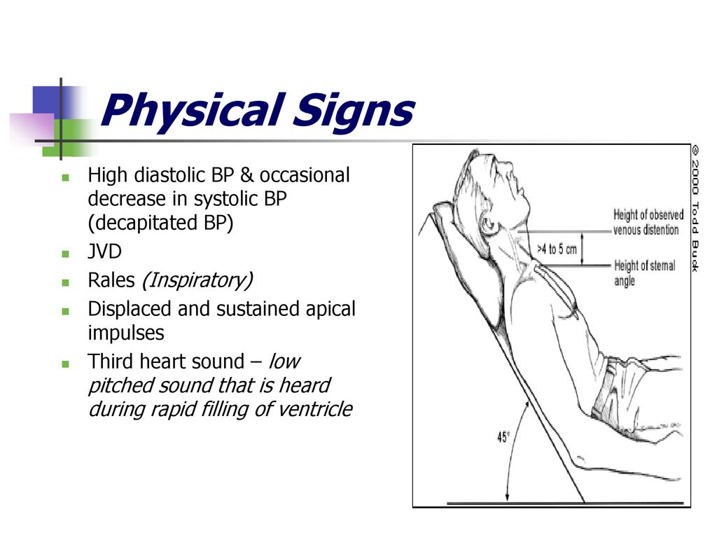 Physical Signs High diastolic BP & occasional decrease in systolic BP (decapitated BP) JVD. Rales (Inspiratory)