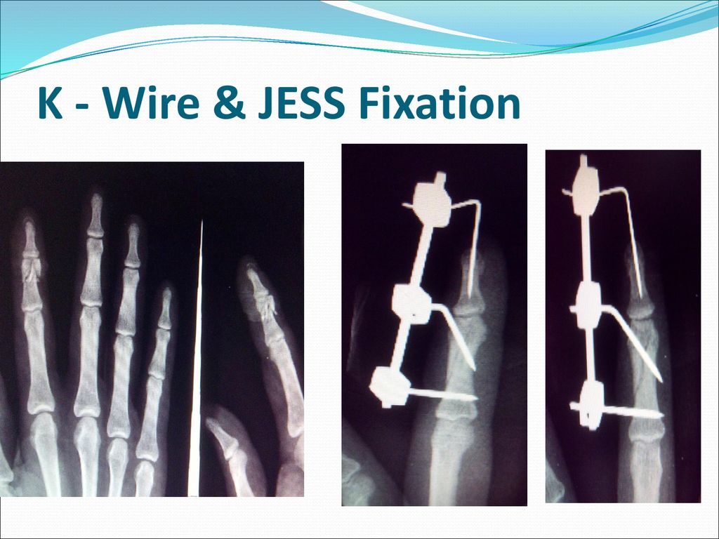K - Wire & JESS Fixation