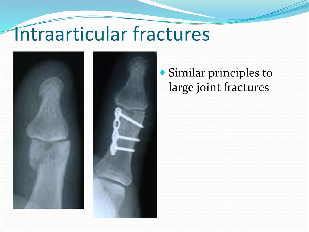 Intraarticular fractures
