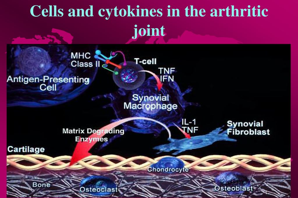 Cells and cytokines in the arthritic joint
