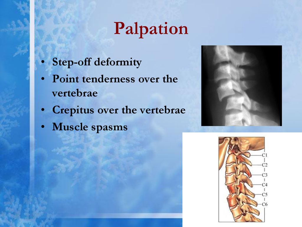 Spine Trauma Andrea L. Williams PhD, RN - ppt download