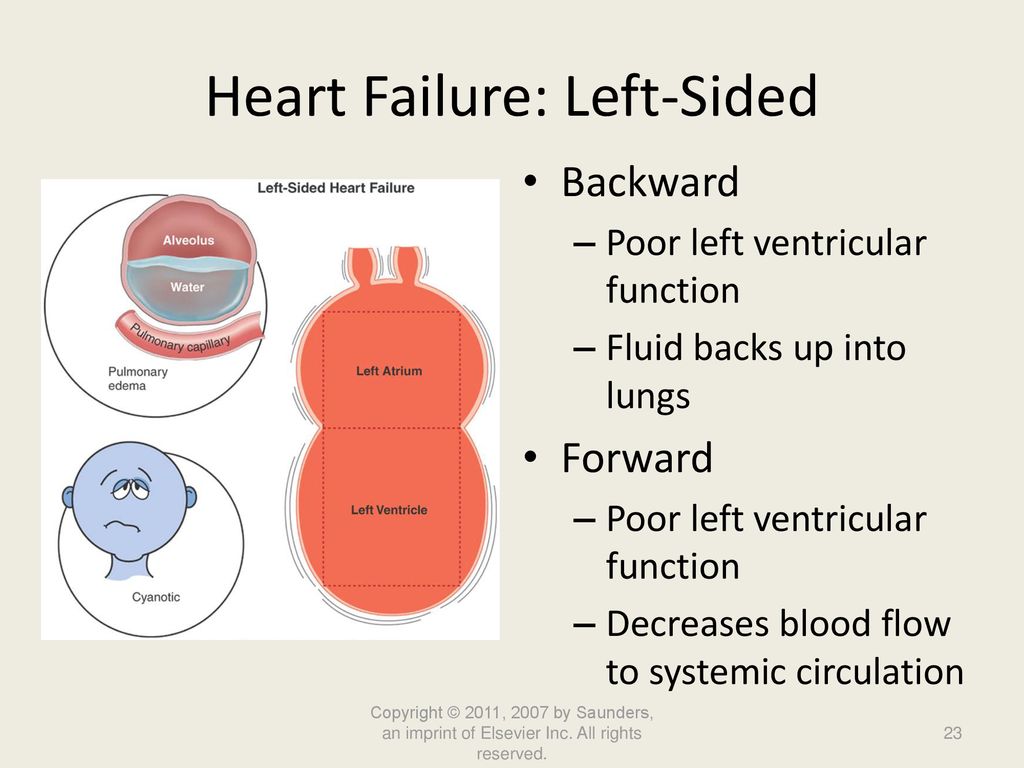 Heart Failure: Left-Sided
