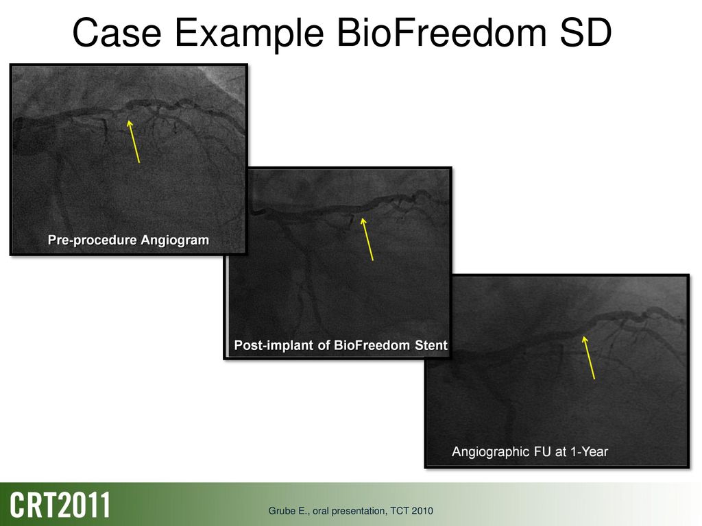 Case Example BioFreedom SD