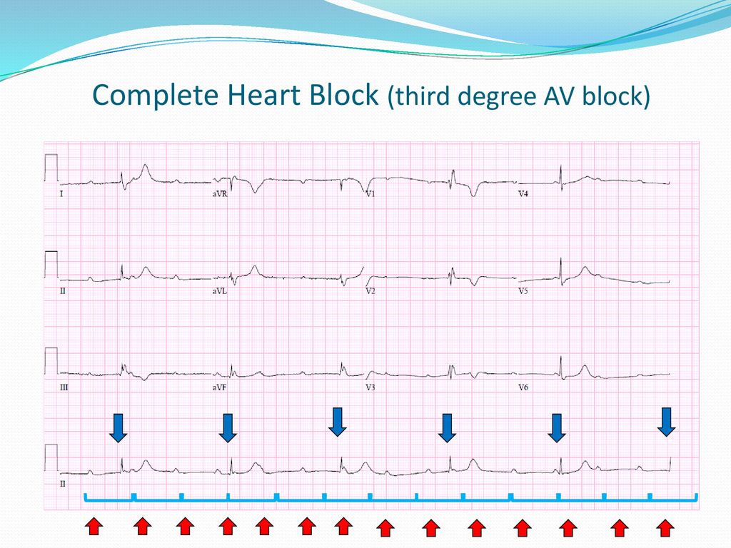 ARRHYTHMIA DR MANSOUR ALQURASHI - ppt download