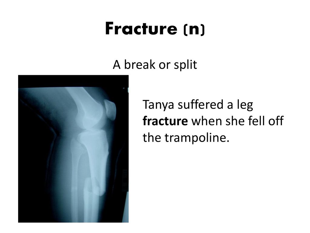 Fracture (n) A break or split Tanya suffered a leg fracture when she fell off the trampoline.
