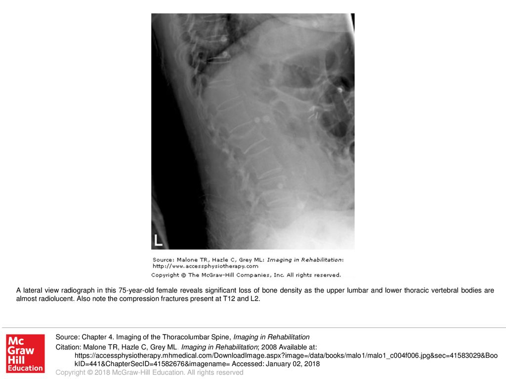 A lateral view radiograph in this 75-year-old female reveals significant loss of bone density as the upper lumbar and lower thoracic vertebral bodies are almost radiolucent. Also note the compression fractures present at T12 and L2.