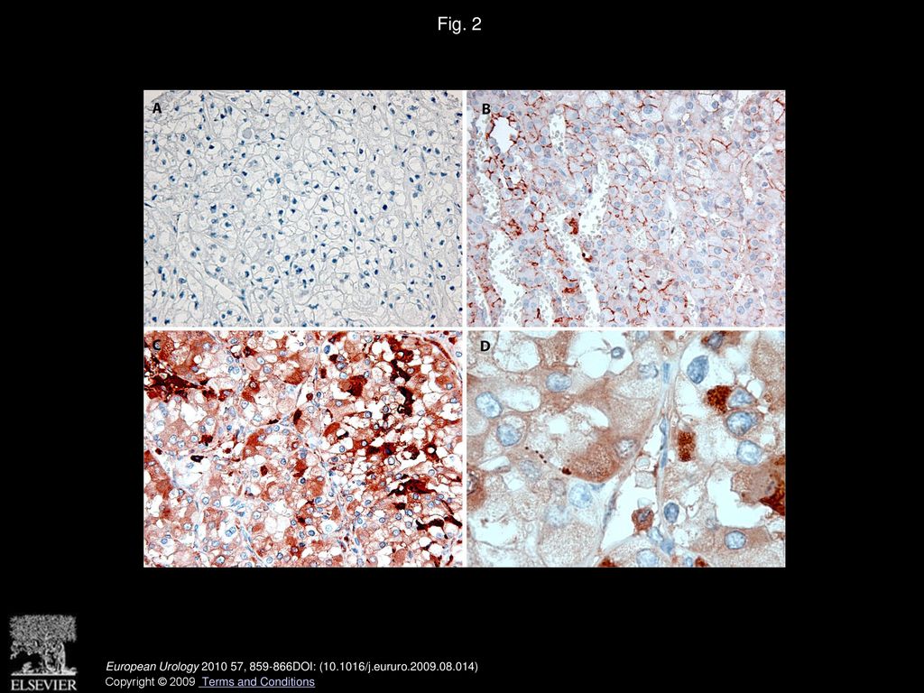 Fig. 2 Expression of SAA1 protein in conventional RCC tissues.