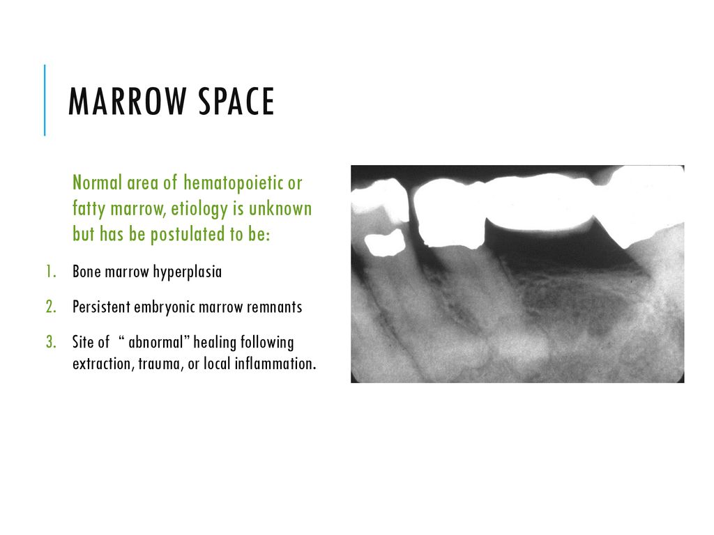 Marrow space Or Focal Osteoporotic Bone marrow