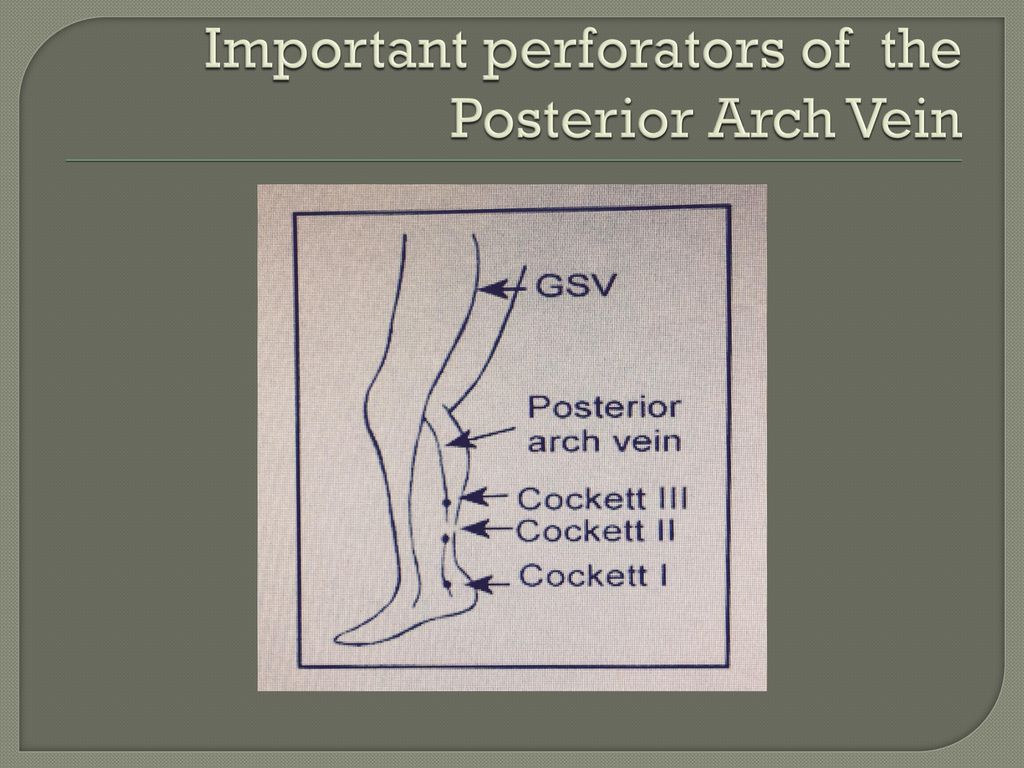 Important perforators of the Posterior Arch Vein