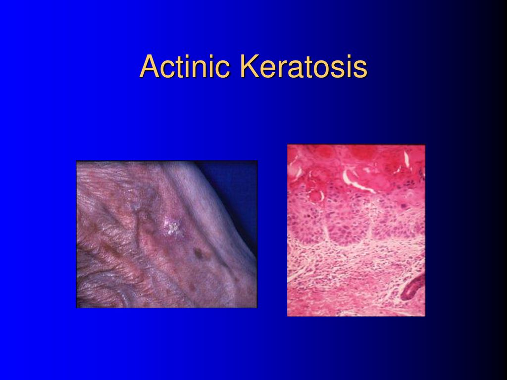 Skin Pathology Epidermis is composed of stratified squamous epithelium ...