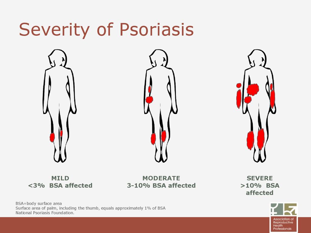 psoriasis body surface area chart