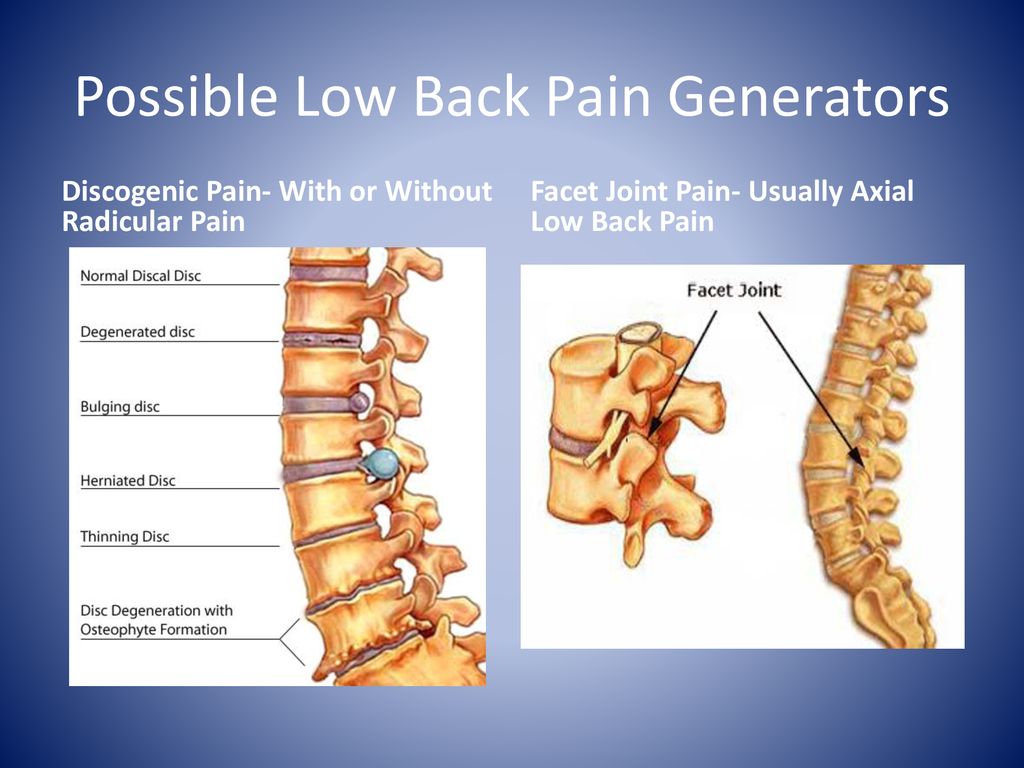 Primary Care Management of the Degenerative Spine - ppt download