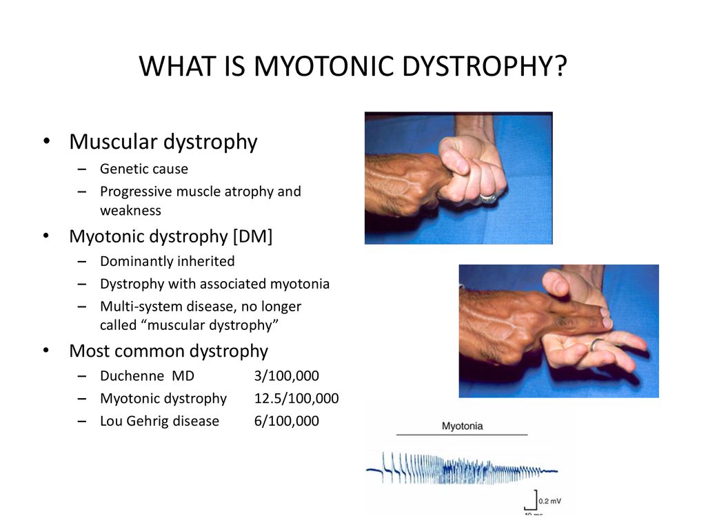 Myotonic dystrophy