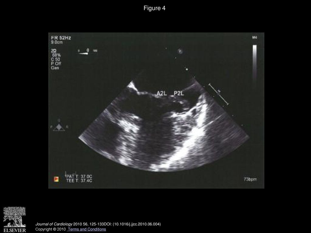 Figure 4 Mitral leaflet anatomy as visualized by transesophageal echocardiography midesophageal transverse plane.