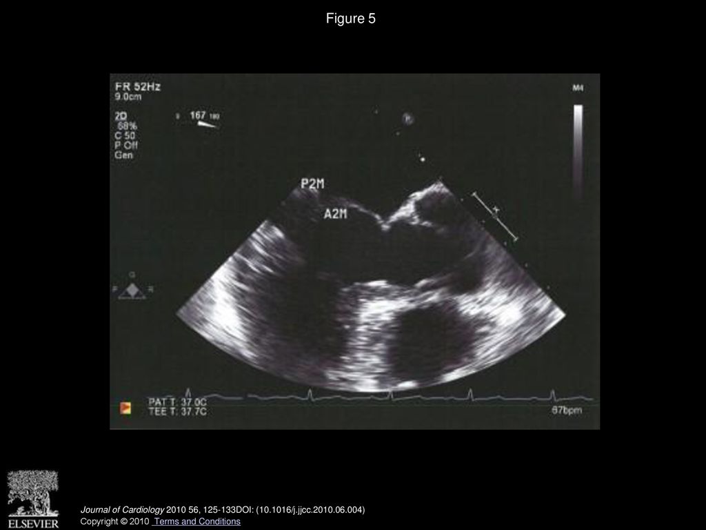 Figure 5 Mitral leaflet anatomy as visualized by transesophageal echocardiography midesophageal long-axis plane.