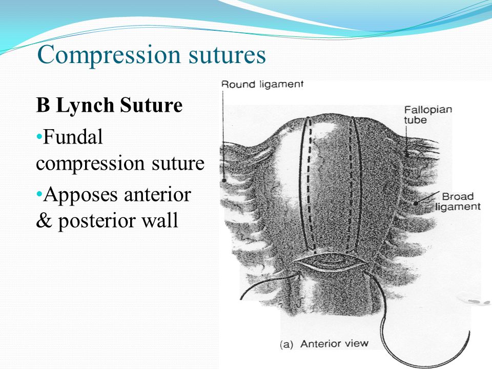 Compression sutures B Lynch Suture Fundal compression suture