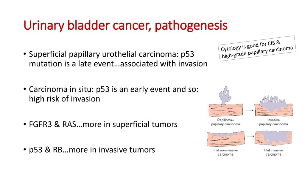 Tumors of kidney and urinary bladder - ppt download