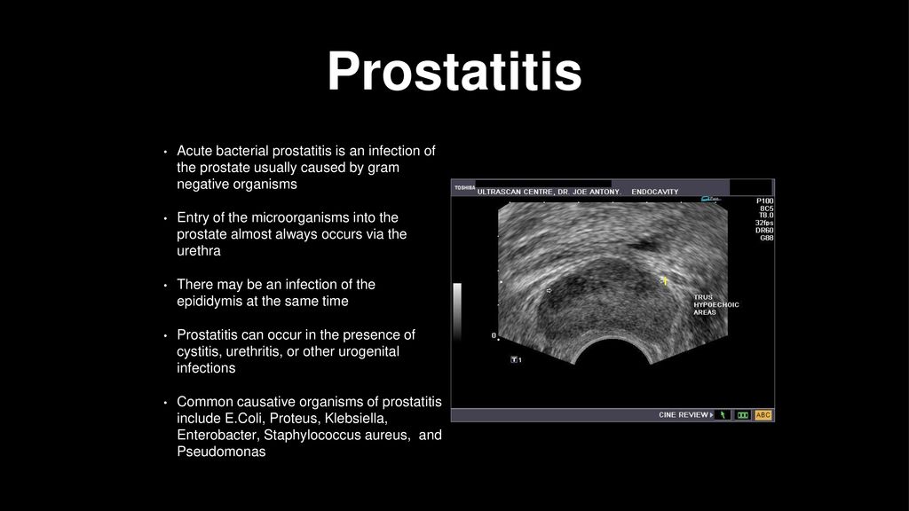 Prostatitis glomerulonephritis