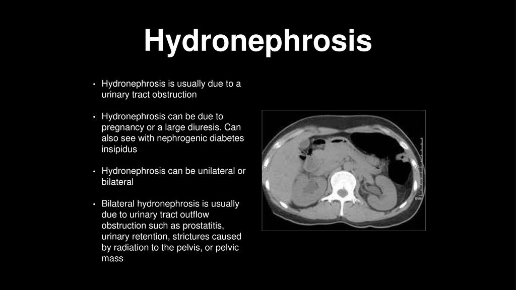 Prostatitis hidronphrosis