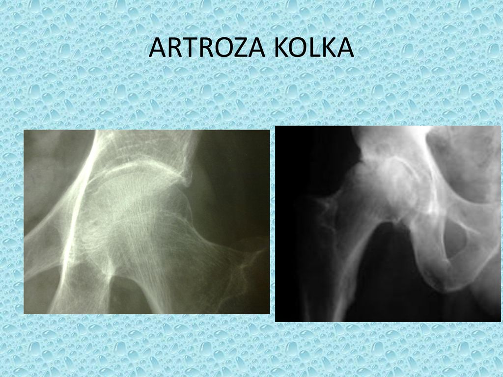 artroza kolka