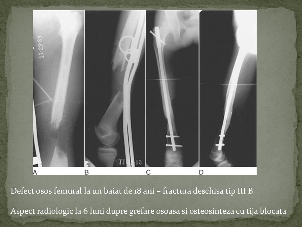Pseudartrozele Dr Rares Sova Conducator Stiintific Dr Paul Dan Sirbu Ppt Download