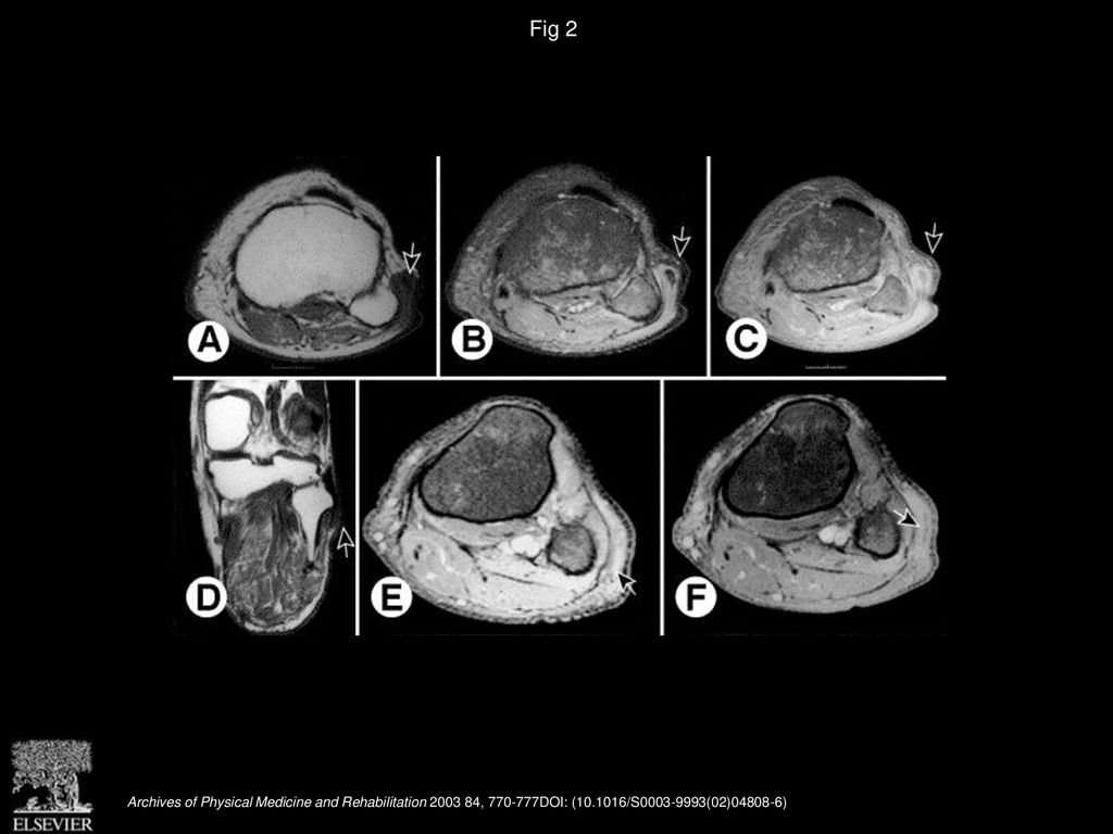 Bursitis, adventitious bursa, localized soft-tissue inflammation, and ...