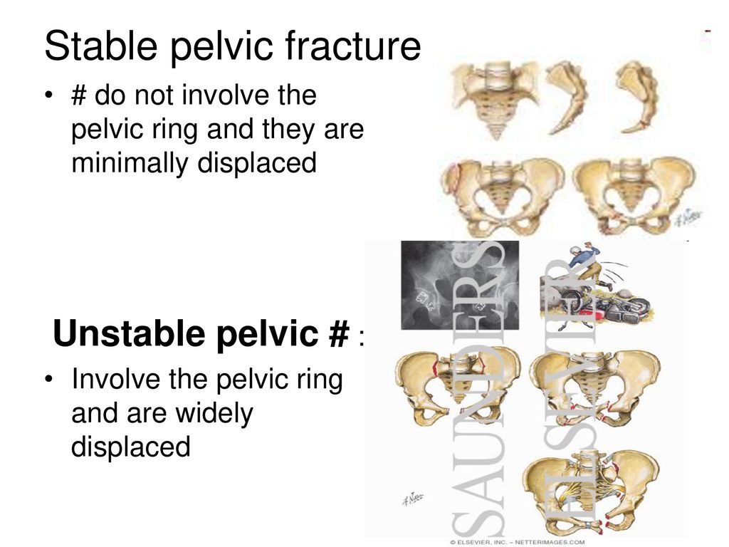 Anatomy, Classification and Radiology of the Pelvic Fracture