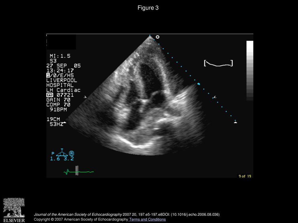 Figure 3 Two-dimensional echocardiogram showing echodense mass in pericardial space compressing atria.