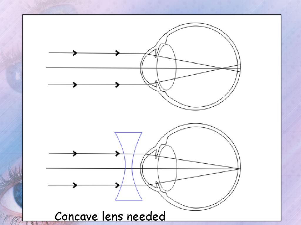 miopie 30 cm restabiliți vederea în funcție de sistemul ochi-diamant