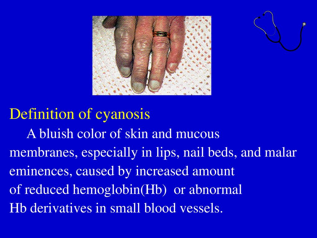 What is Cape Cyanosis? (2024)
