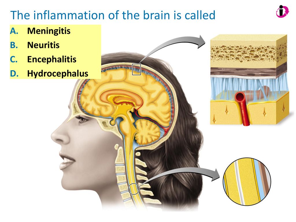 The inflammation of the brain is called