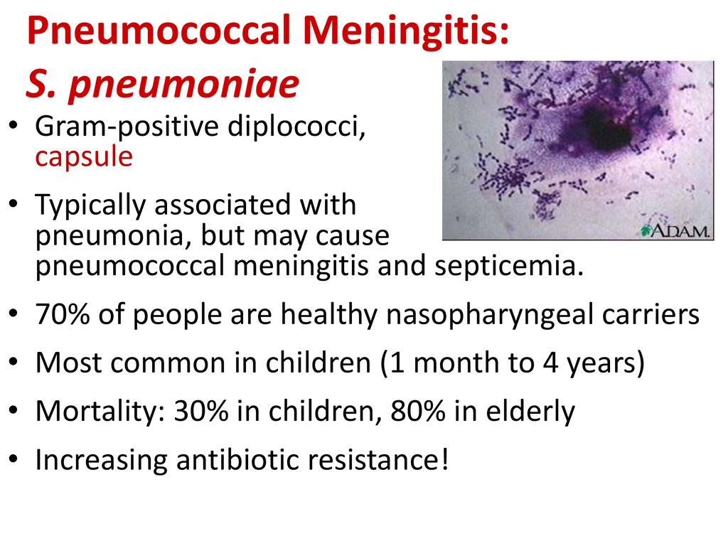 Pneumococcal Meningitis: S. pneumoniae