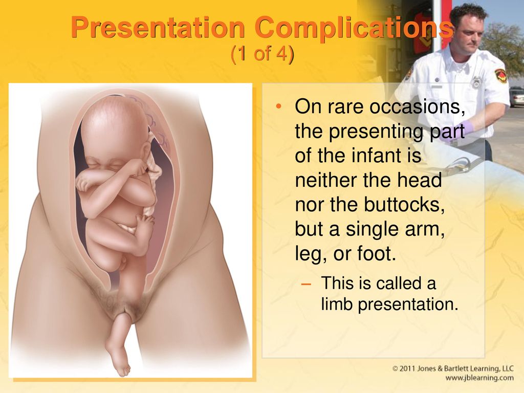 Presentation Complications (1 of 4)
