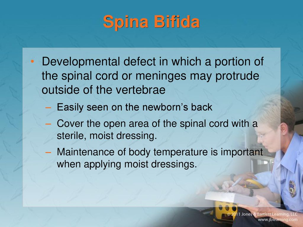 Spina Bifida Developmental defect in which a portion of the spinal cord or meninges may protrude outside of the vertebrae.