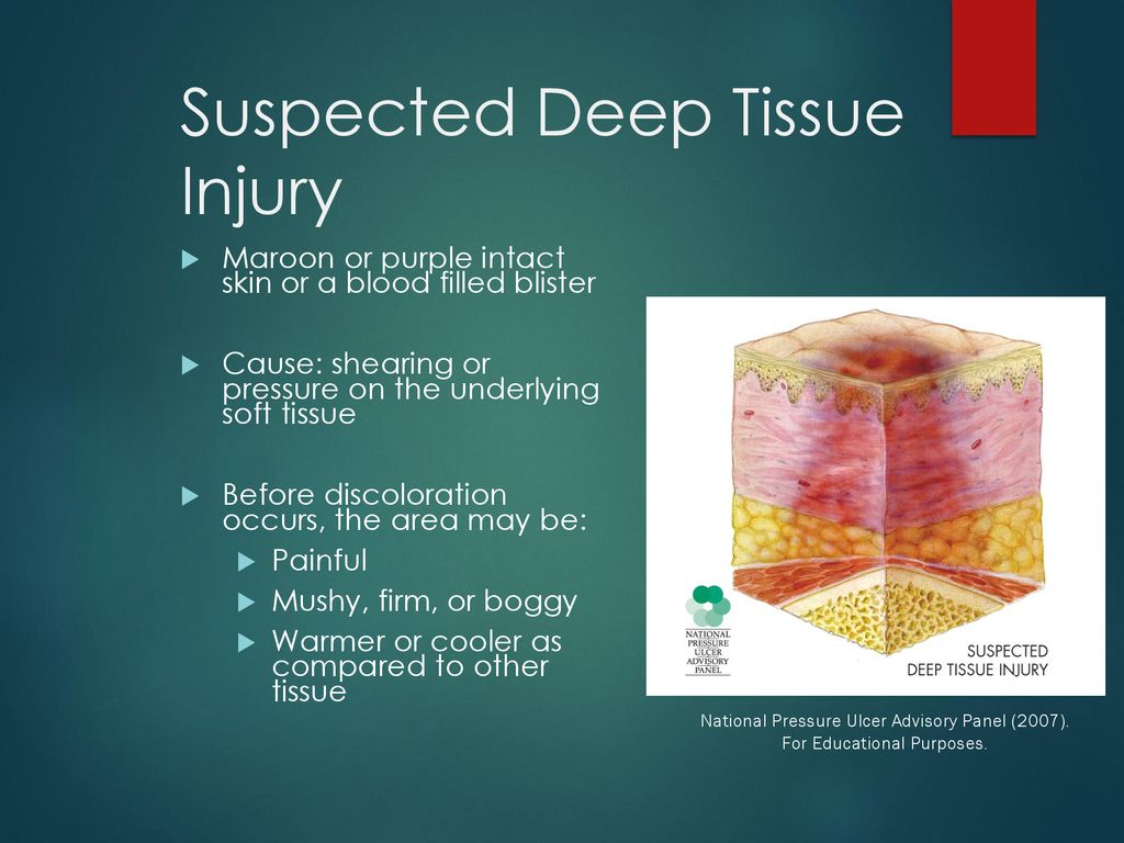 PRESSURE ULCERS AND WOUND CARE - ppt download