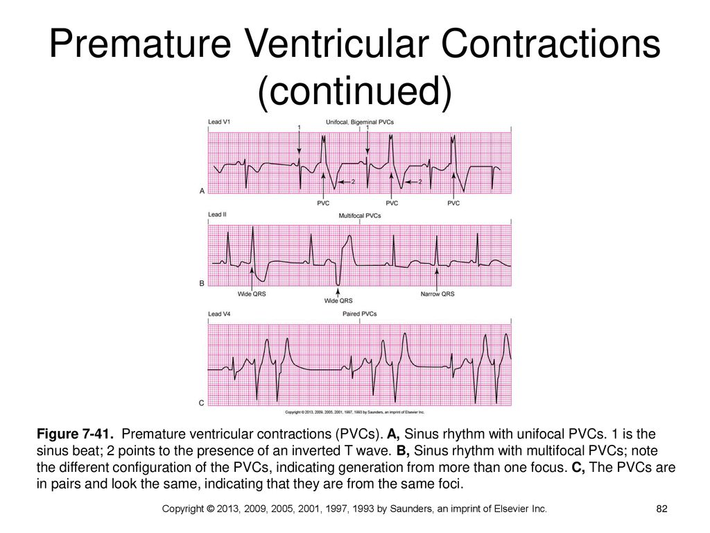 Dysrhythmia Interpretation And Management Ppt Download