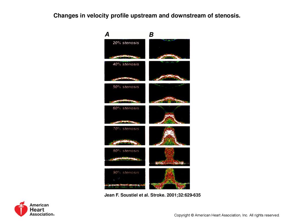 Changes in velocity profile upstream and downstream of stenosis.
