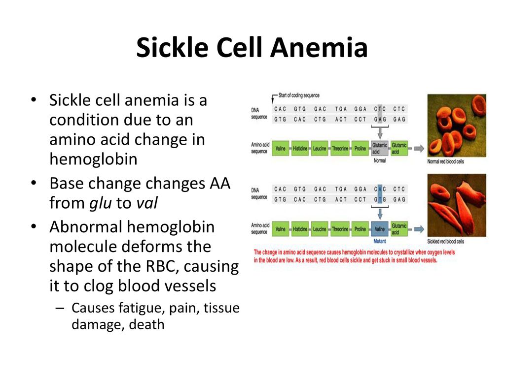 Sickle Cell Anemia Sickle cell anemia is a condition due to an amino acid change in hemoglobin. Base change changes AA from glu to val.