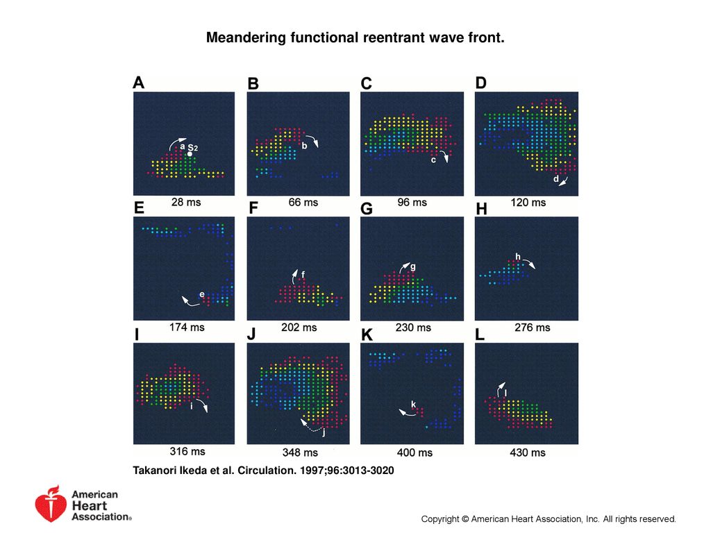 Meandering functional reentrant wave front.