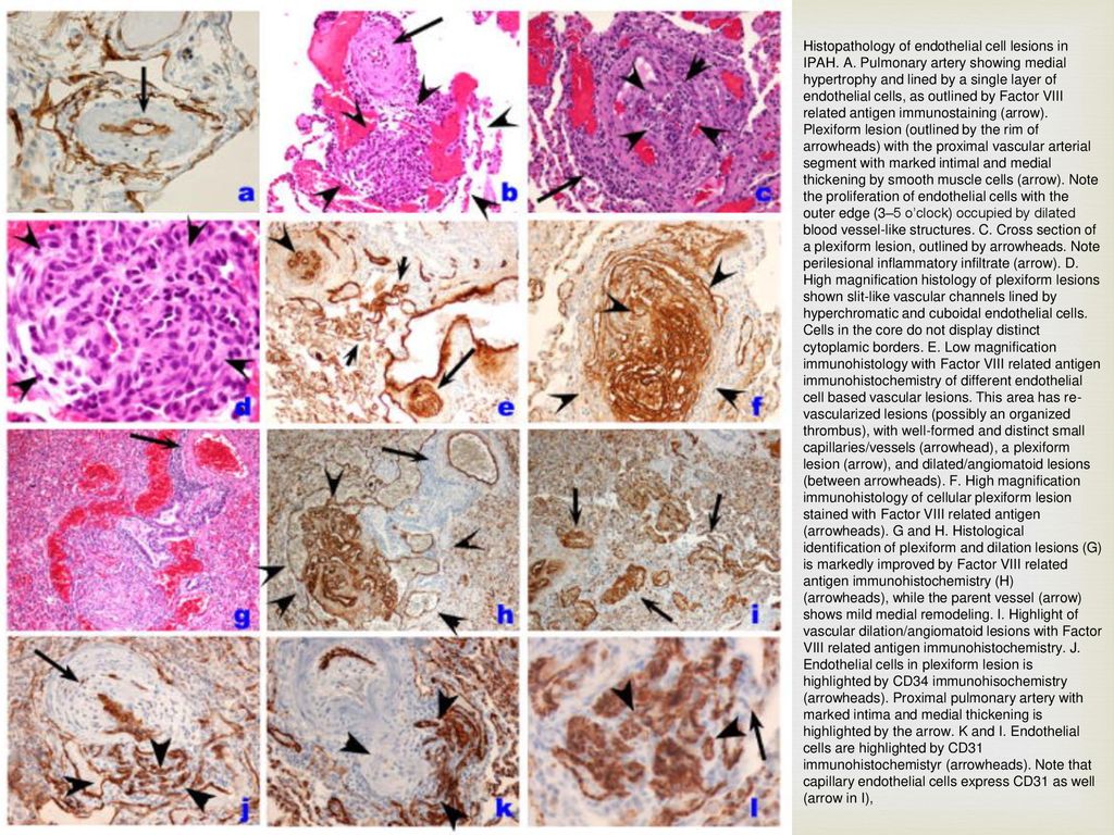 Histopathology of endothelial cell lesions in IPAH. A