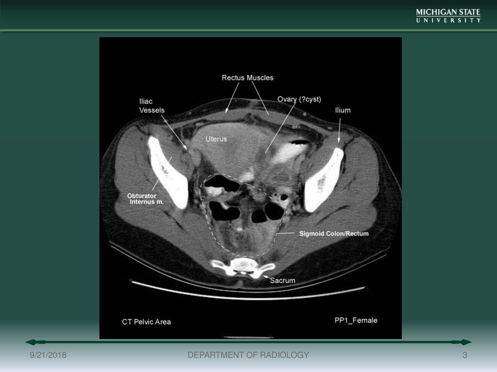 Pelvic Muscle Ct Anatomy Anatomy Drawing Diagram