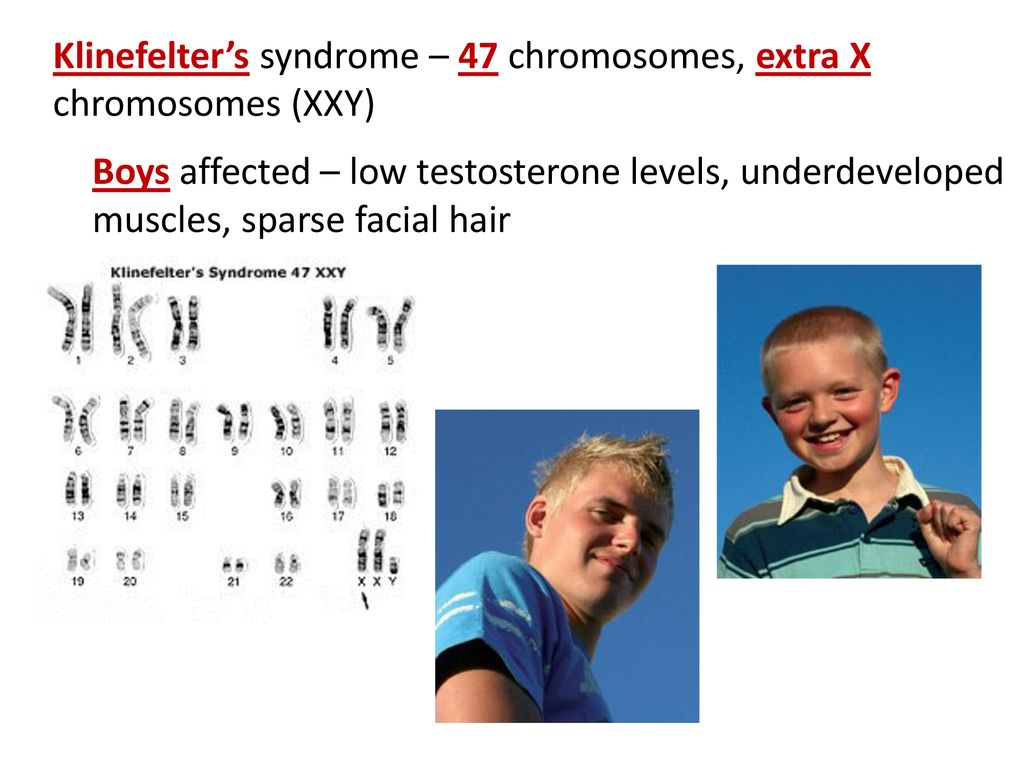 Xxy хромосома. Xxy синдром Клайнфельтера. Синдром Клайнфельтера внешность. Синдром Клайнфельтера 47 xxy.