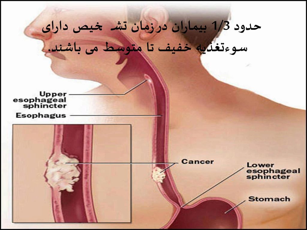 Пищевода 4 стадия. Злокачественные опухоли пищевода. Злокачественное новообразование средней трети пищевода.