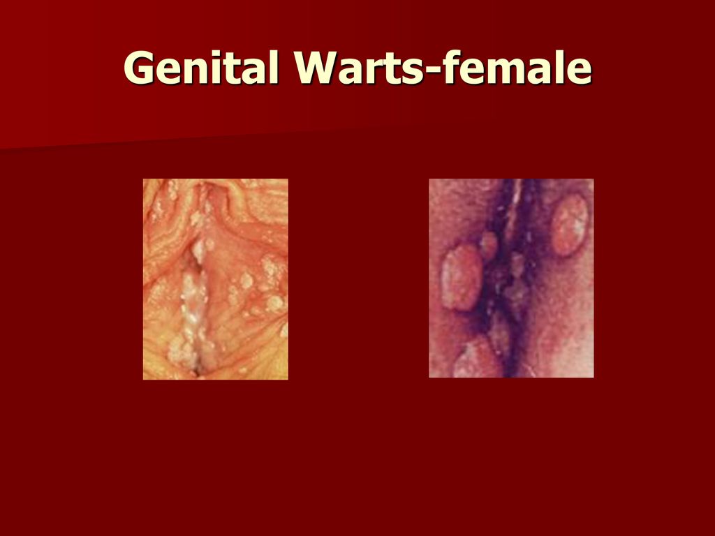 Genital warts in women