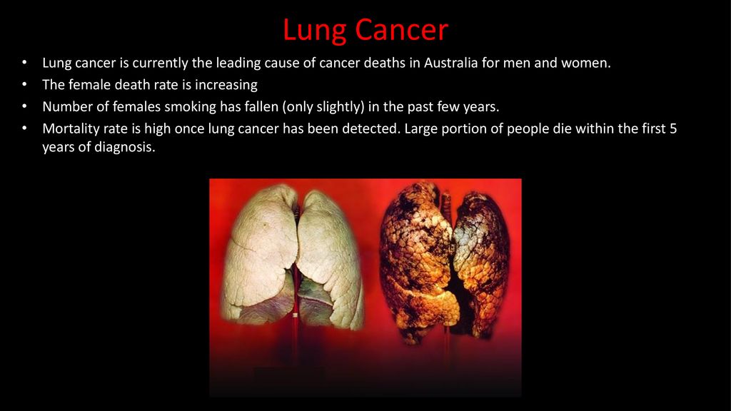 Lung Cancer Lung cancer is currently the leading cause of cancer deaths in Australia for men and women.